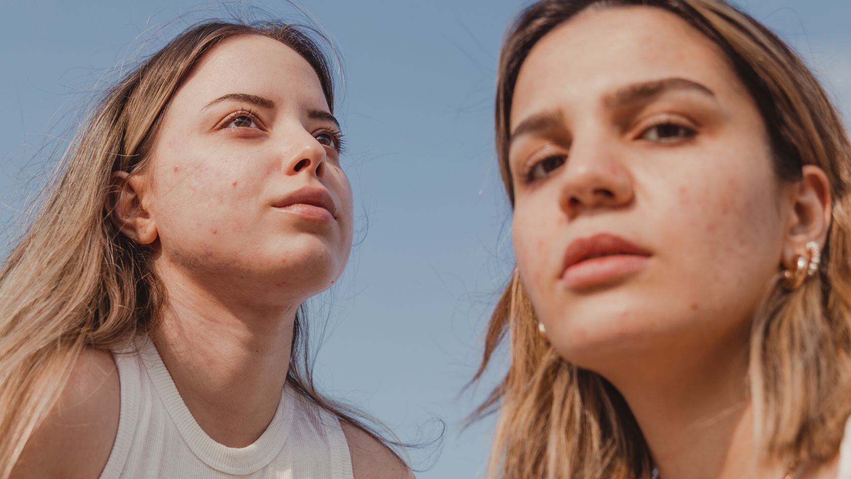 Cómo cuidar la piel con acné